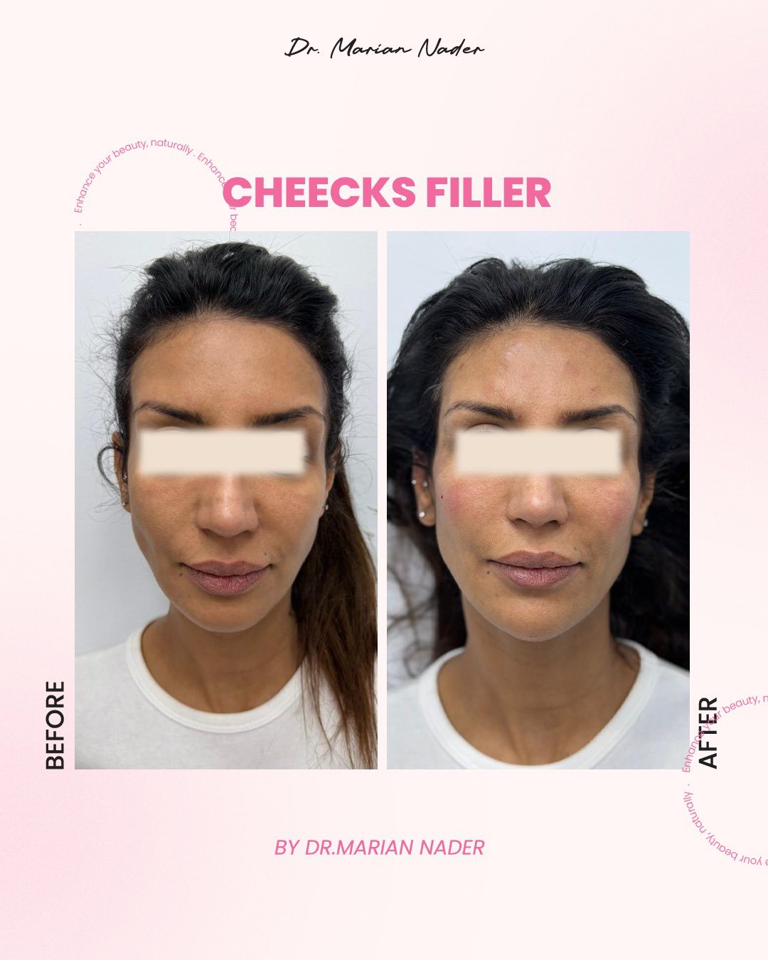 Cheek filler before and after, front view