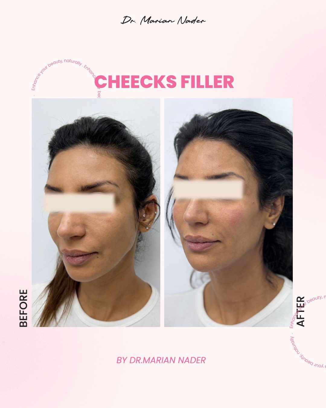 Cheek filler side profile before and after