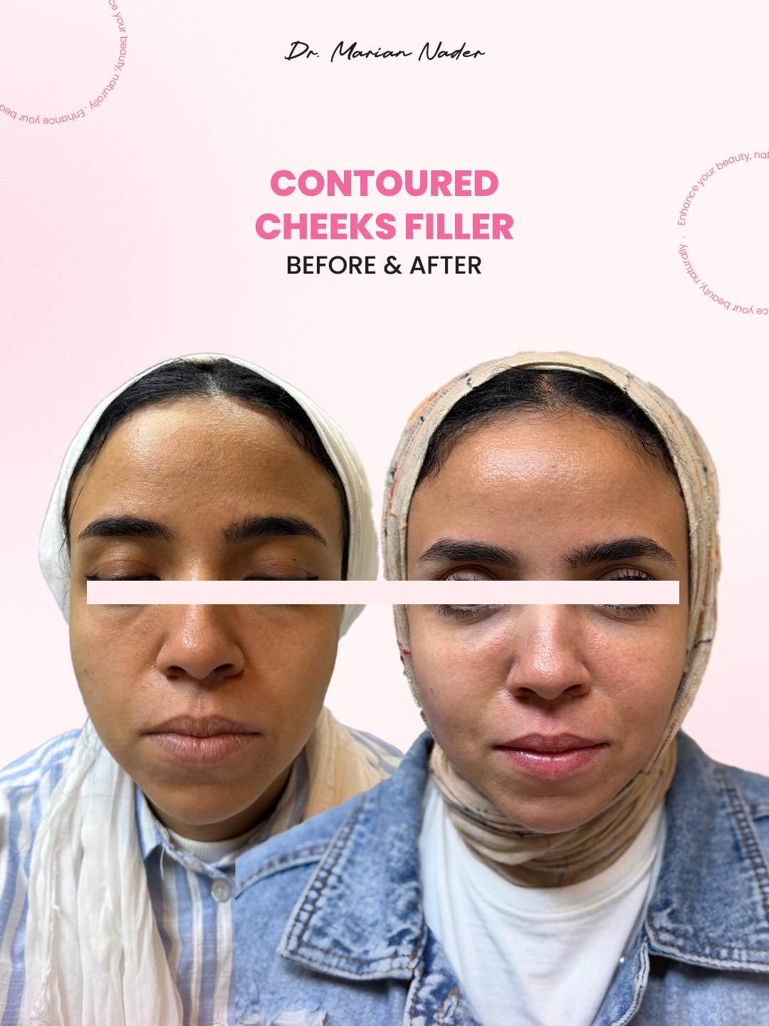 Contoured cheeks filler front view before and after