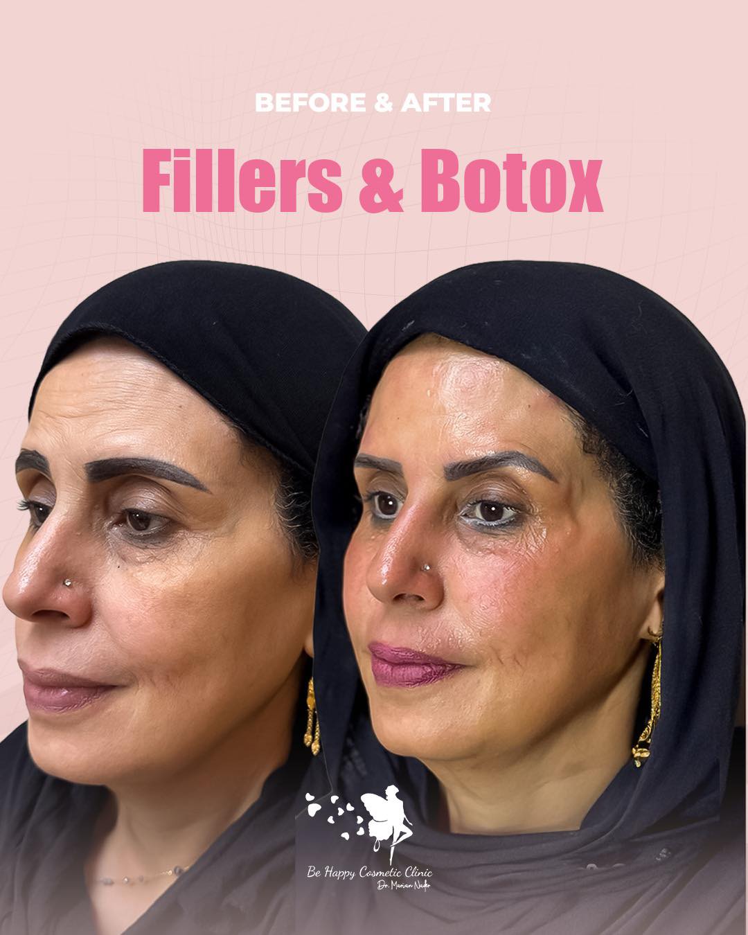 Fillers and Botox combination side profile before and after