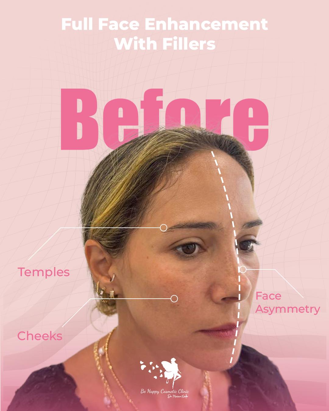 Full face enhancement angled view, temples cheeks asymmetry mapped