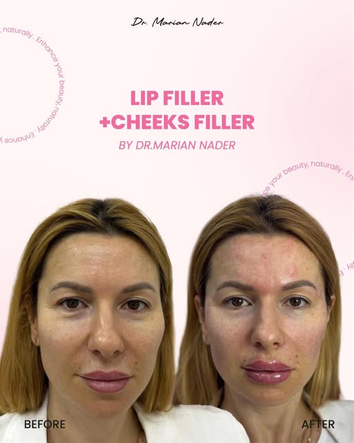 Lip filler with cheek filler combination before and after