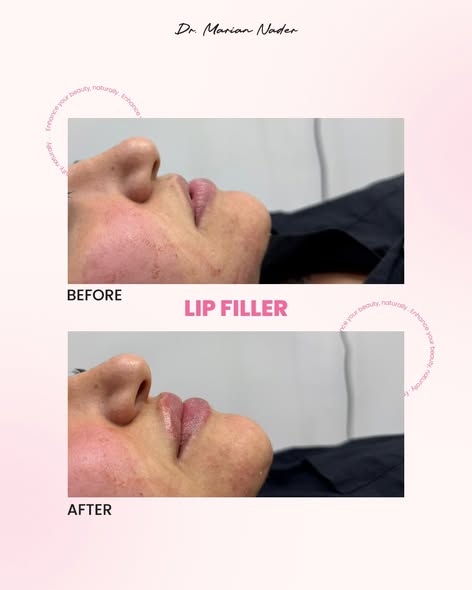 Lip filler side profile before and after
