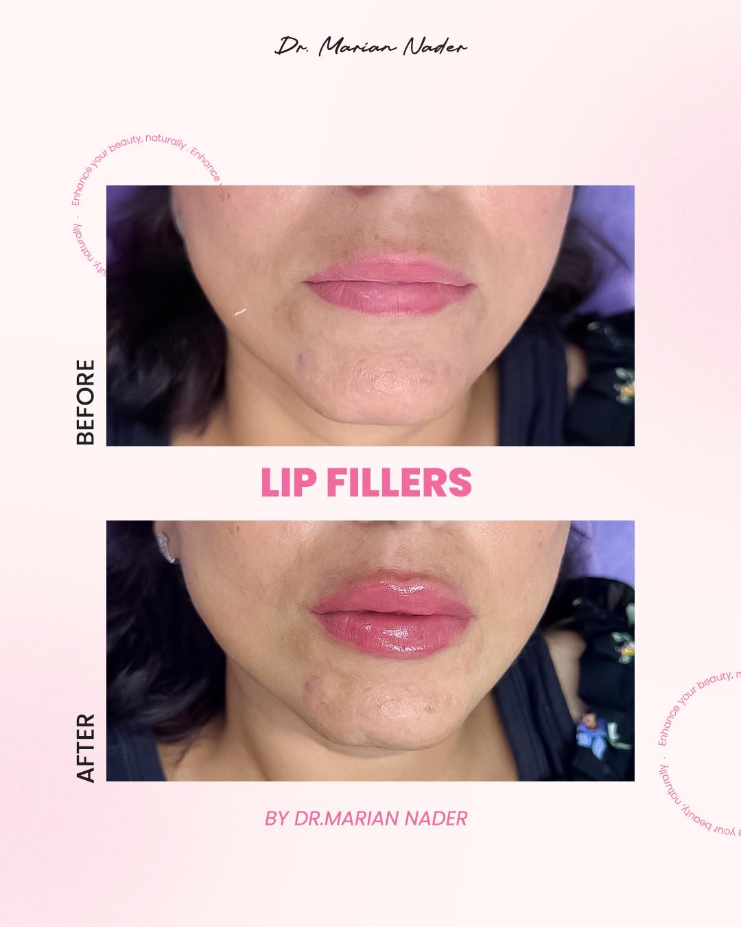 Soft natural lip filler before and after by Dr. Marian Nader