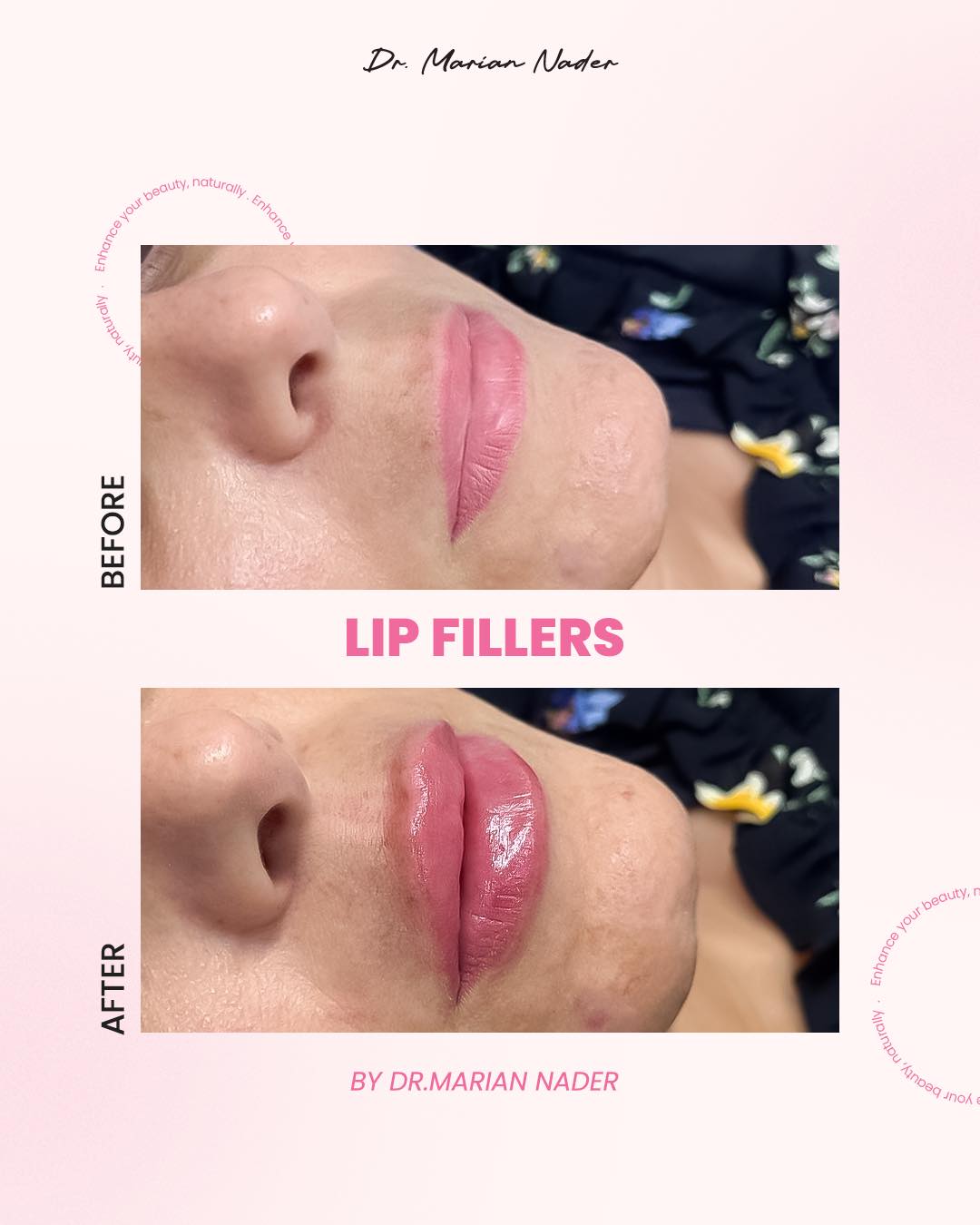 Glossy lip filler side profile before and after