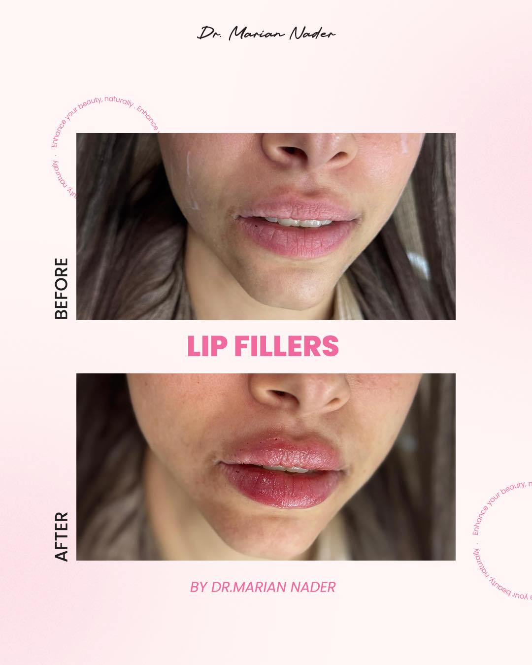 Lip volume restoration before and after