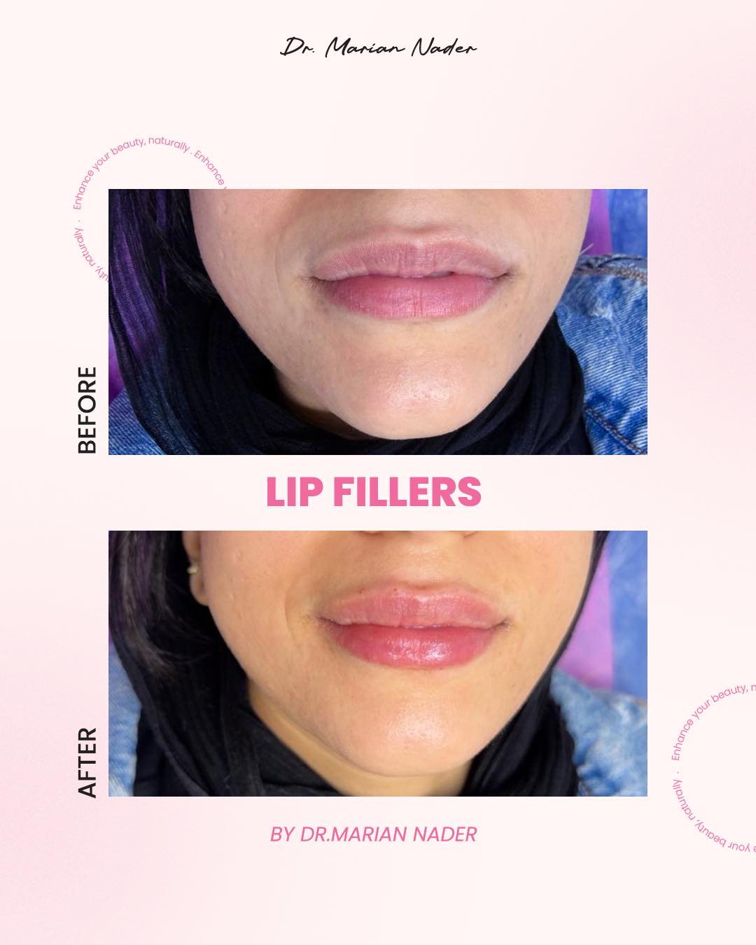 Subtle lip shape enhancement before and after