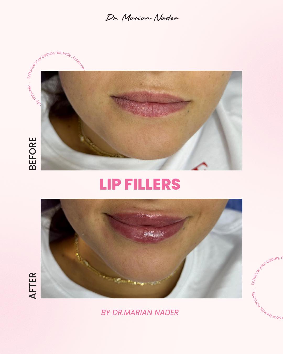 Refined lip border filler before and after