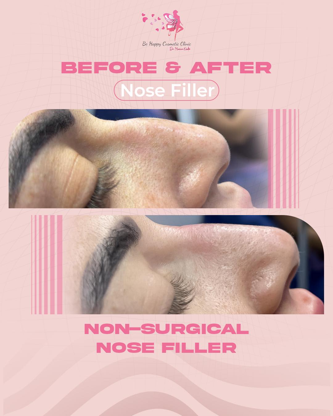 Non-surgical nose filler reshaping before and after, side view