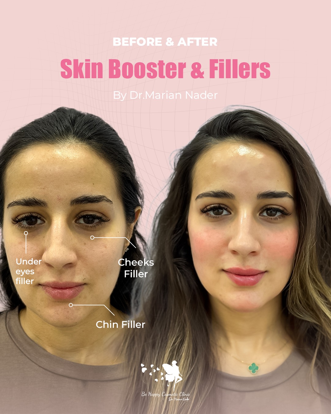 Skin booster with under-eye, cheek and chin fillers before and after